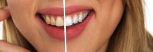 Existe remédio para sensibilidade nos dentes após clareamento?