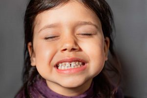 Hipoplasia do esmalte dentário: descubra o que é, causas e tratamento
