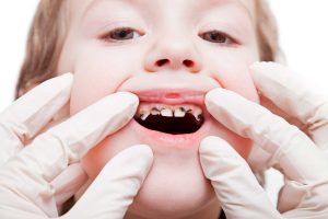 Criança com dente podre: o que fazer?