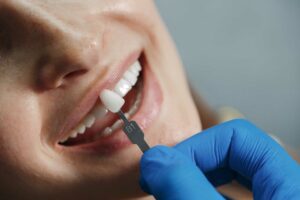 Mito ou verdade: facetas de resina estragam os dentes?