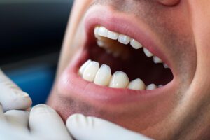 O que fazer quando tiver sensibilidade nos dentes?